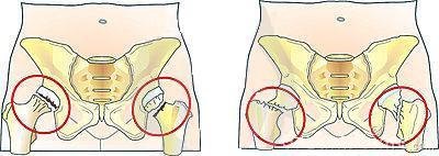Combnyaktörés gyógytornája Combnyaktörés gyógytornája