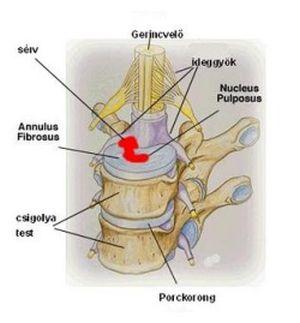 Gerincsérv profi gyógytornász