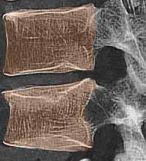 Scheuermann-betegség gyógytornája