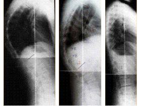 Scheuermann-betegség gyógytornája